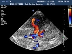 Ricerca di fonti emboligene  nel cardioembolismo - Dott. Umberto Conti